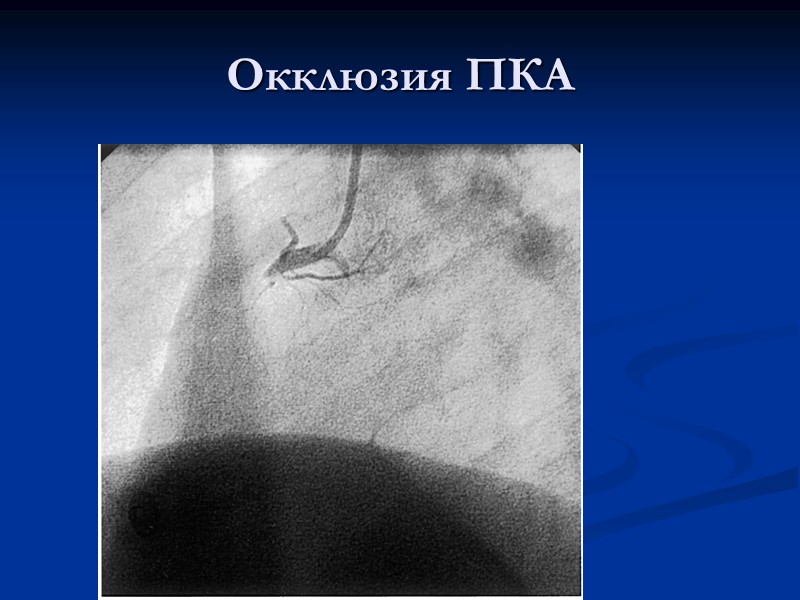 Окклюзия ПКА